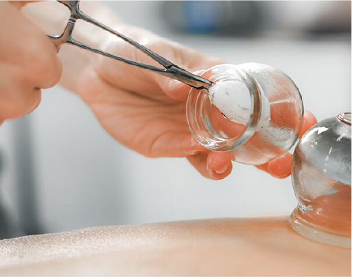 Healing Benefits of Cupping: 4 Modalities of Cupping